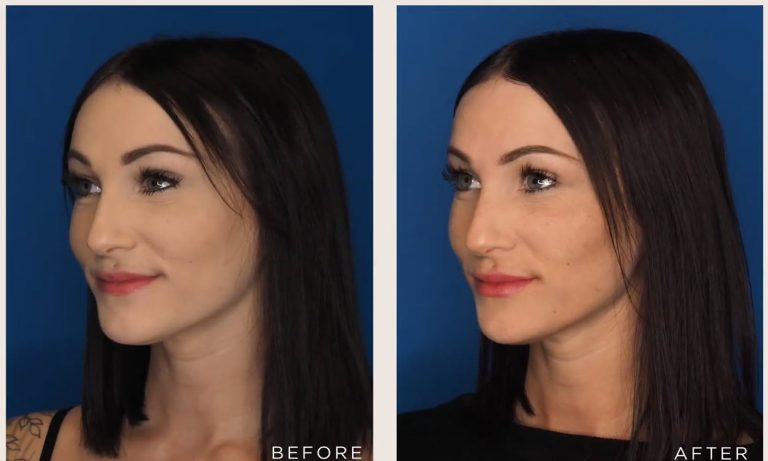 Before and after lip filler treatment showing natural enhancement